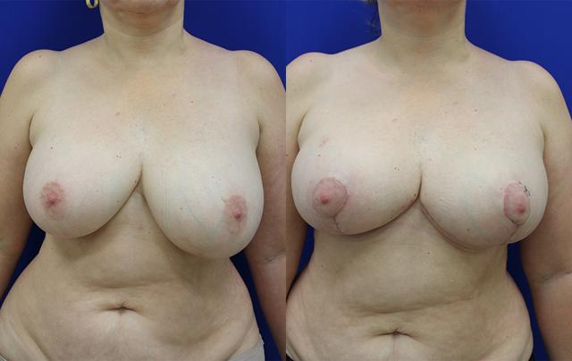 Breast Reduction result at Jason Cooper, MD in Jupiter, FL