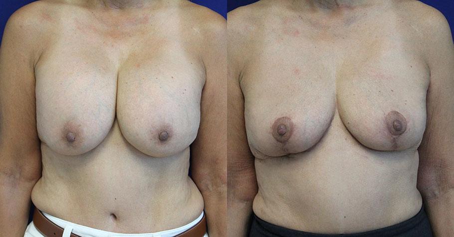 Jason Cooper, MD breast implant removal result — Jupiter, FL