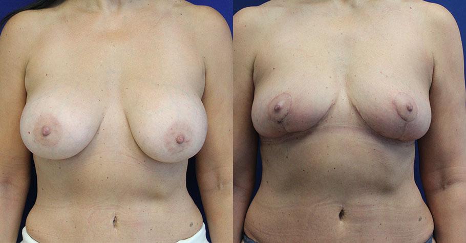 Jason Cooper, MD breast implant removal result — Jupiter, FL