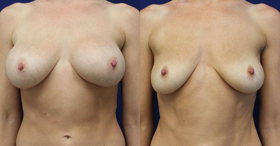 Jason Cooper, MD breast implant removal result — Jupiter, FL