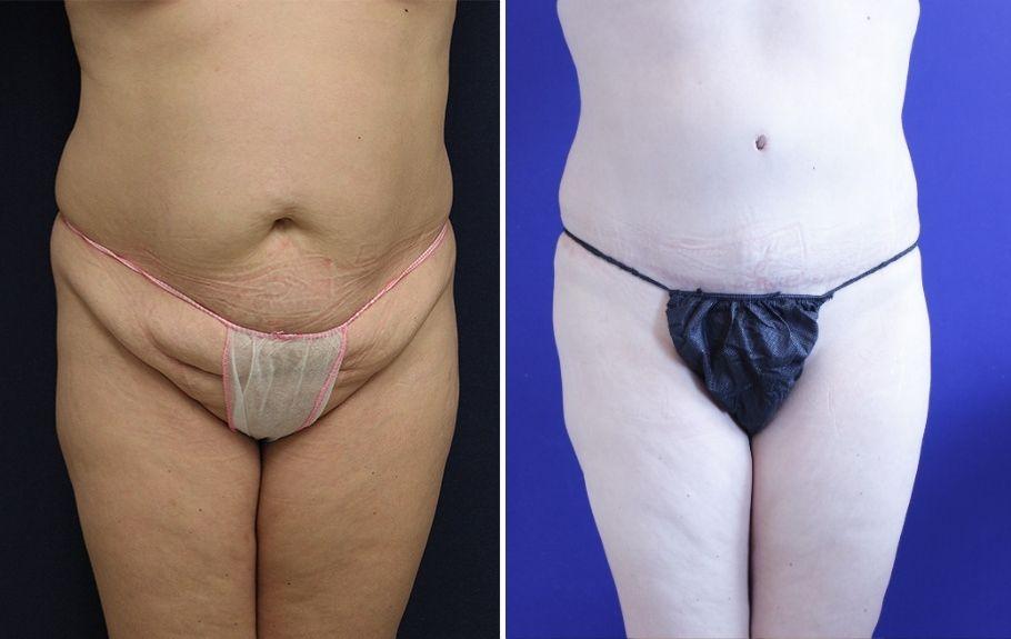Jason Cooper, MD tummy tuck result — Jupiter, FL