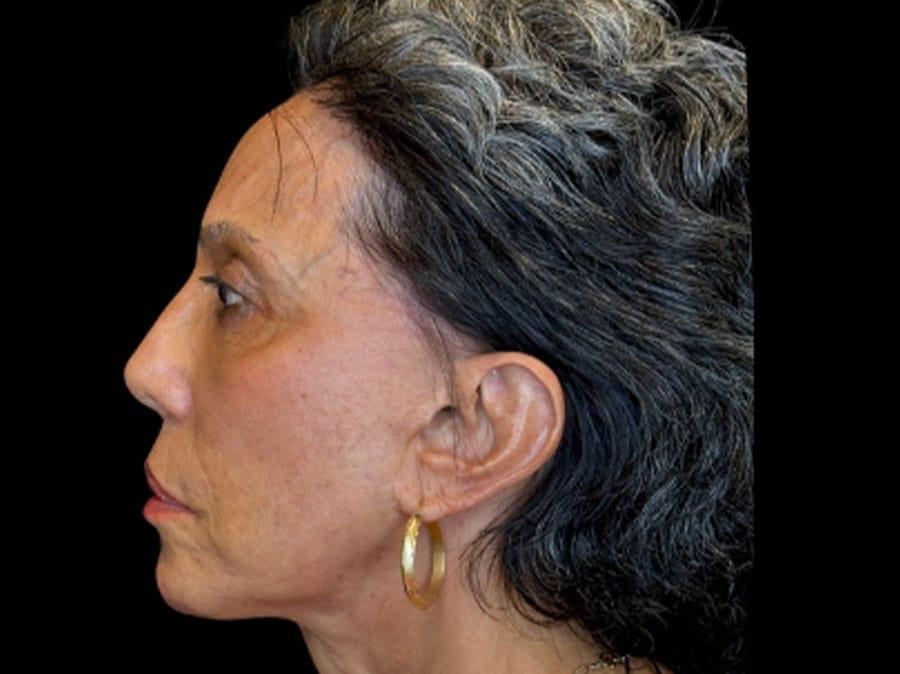Maan Plastic Surgery rhinoplasty after — Los Gatos, CA
