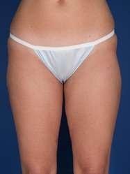 Monarch Plastic Surgery liposuction after — Atlanta, GA