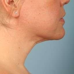 Neck Liposuction after at Monarch Plastic Surgery in Atlanta, GA