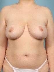 Monarch Plastic Surgery breast reduction after — Atlanta, GA