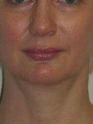 Monarch Plastic Surgery neck liposuction after — Atlanta, GA