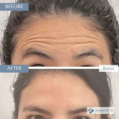 Botox result at Sanctuaire MD, Best Medical Spa in Lafayette, CA in Lafayette, CA