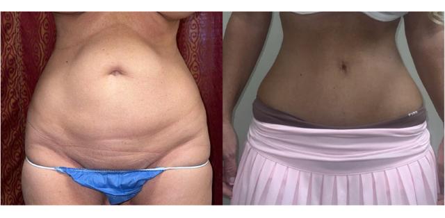 Mommy Makeover result at Whitlock Cosmetic Center of Oklahoma in Tulsa, OK