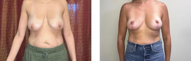 Breast Lift result at Whitlock Cosmetic Center of Oklahoma in Tulsa, OK