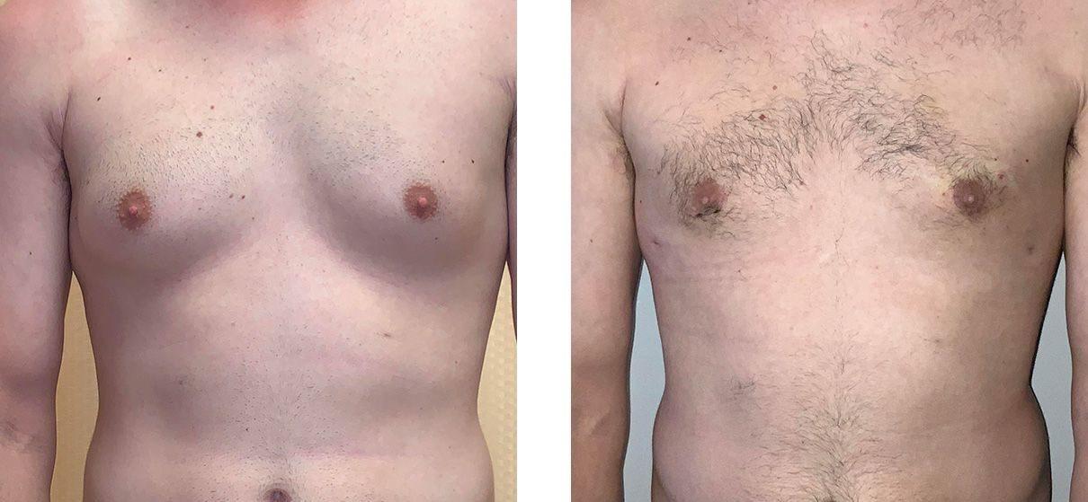 Whitlock Cosmetic Center of Oklahoma gynecomastia result — Tulsa, OK