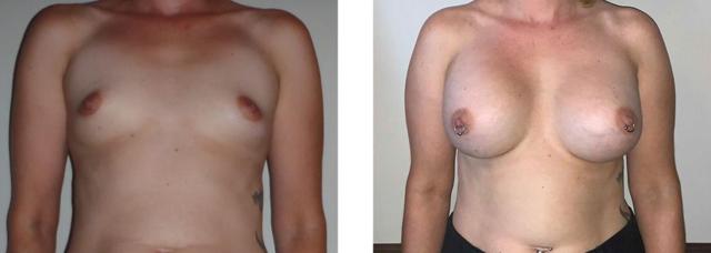 Breast Augmentation result at Whitlock Cosmetic Center of Oklahoma in Tulsa, OK