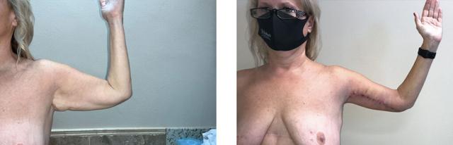 Arm Lift result at Whitlock Cosmetic Center of Oklahoma in Tulsa, OK