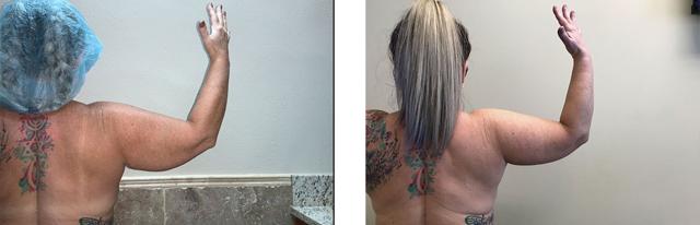 Arm Lift result at Whitlock Cosmetic Center of Oklahoma in Tulsa, OK