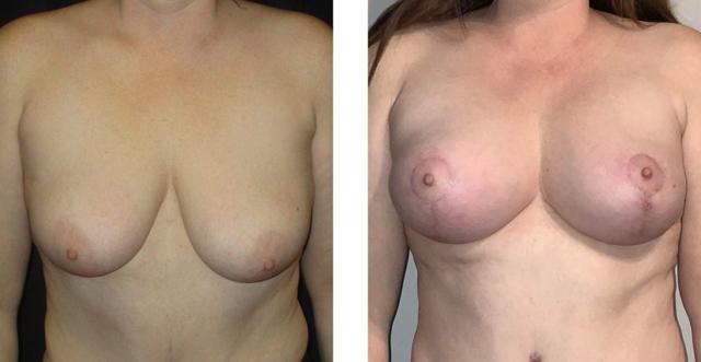 Breast Lift result at Whitlock Cosmetic Center of Oklahoma in Tulsa, OK