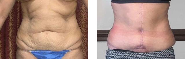 Mommy Makeover result at Whitlock Cosmetic Center of Oklahoma in Tulsa, OK