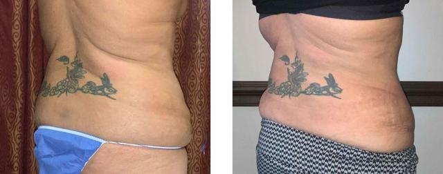 Mommy Makeover result at Whitlock Cosmetic Center of Oklahoma in Tulsa, OK