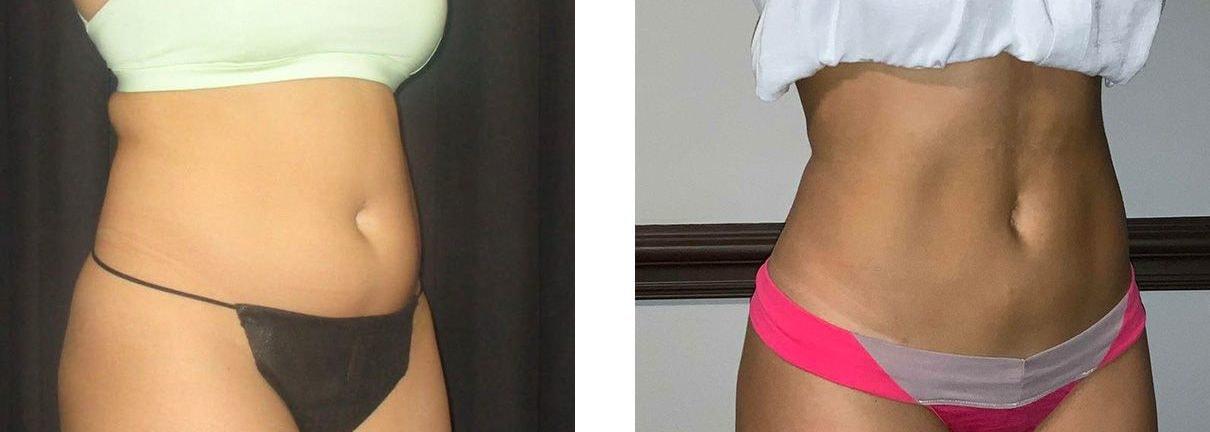 Whitlock Cosmetic Center of Oklahoma liposuction result — Tulsa, OK