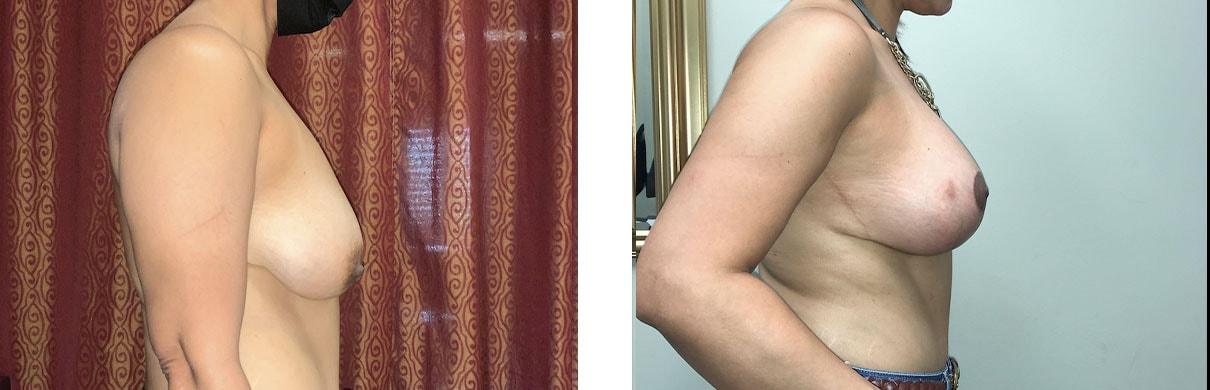 Whitlock Cosmetic Center of Oklahoma breast augmentation result — Tulsa, OK