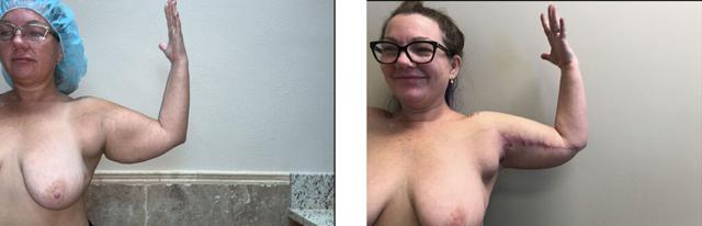 Arm Lift result at Whitlock Cosmetic Center of Oklahoma in Tulsa, OK