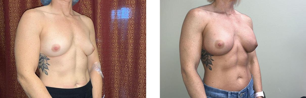 Whitlock Cosmetic Center of Oklahoma breast augmentation result — Tulsa, OK