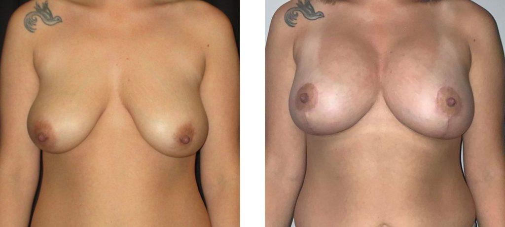 Whitlock Cosmetic Center of Oklahoma breast augmentation result — Tulsa, OK