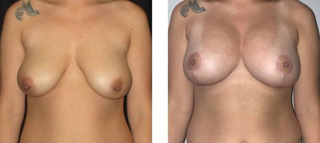 Fat Transfer Breast Augmentation result at Whitlock Cosmetic Center of Oklahoma in Tulsa, OK