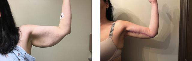 Arm Lift result at Whitlock Cosmetic Center of Oklahoma in Tulsa, OK