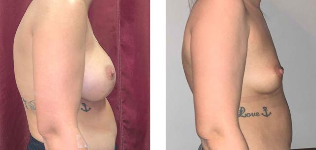 Breast Lift result at Whitlock Cosmetic Center of Oklahoma in Tulsa, OK
