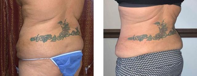 Mommy Makeover result at Whitlock Cosmetic Center of Oklahoma in Tulsa, OK