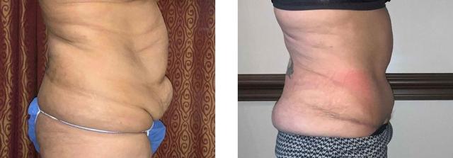 Mommy Makeover result at Whitlock Cosmetic Center of Oklahoma in Tulsa, OK