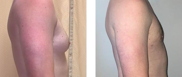 Gynecomastia Surgery result at Whitlock Cosmetic Center of Oklahoma in Tulsa, OK