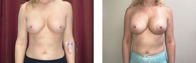 Breast Augmentation result at Whitlock Cosmetic Center of Oklahoma in Tulsa, OK