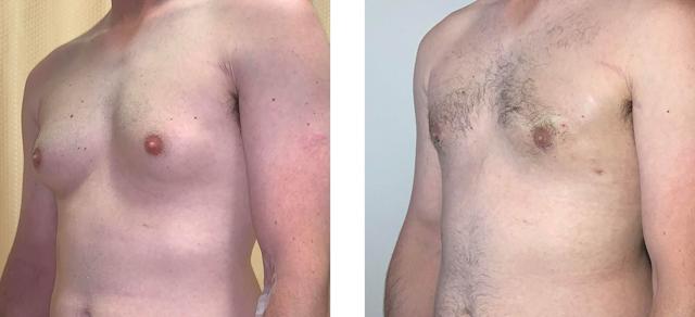 Gynecomastia Surgery result at Whitlock Cosmetic Center of Oklahoma in Tulsa, OK