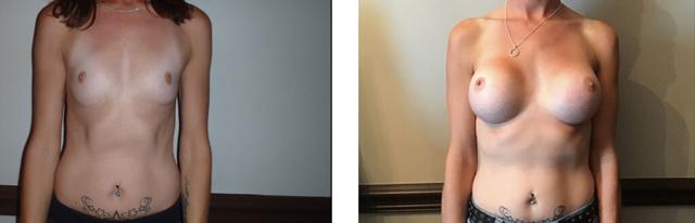 Breast Augmentation result at Whitlock Cosmetic Center of Oklahoma in Tulsa, OK
