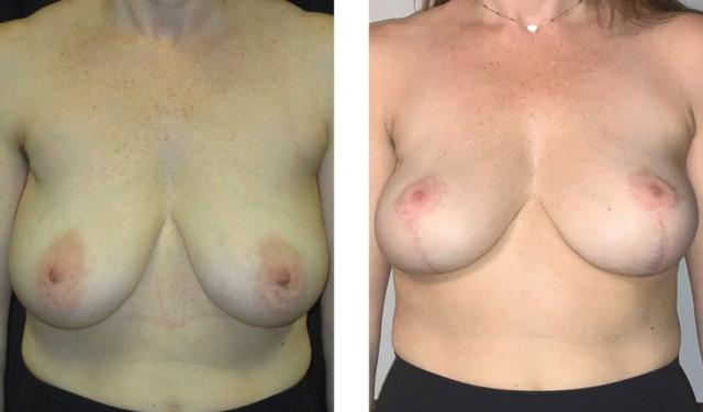 Breast Lift result at Whitlock Cosmetic Center of Oklahoma in Tulsa, OK