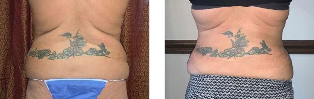 Mommy Makeover result at Whitlock Cosmetic Center of Oklahoma in Tulsa, OK