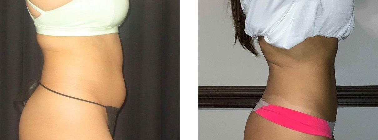 Whitlock Cosmetic Center of Oklahoma liposuction result — Tulsa, OK