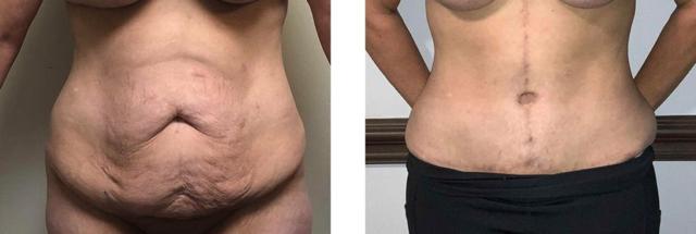 Mommy Makeover result at Whitlock Cosmetic Center of Oklahoma in Tulsa, OK