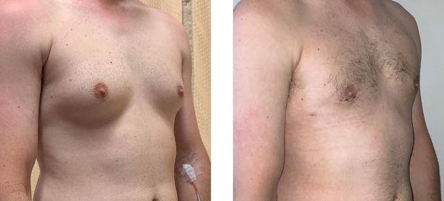 Gynecomastia Surgery result at Whitlock Cosmetic Center of Oklahoma in Tulsa, OK