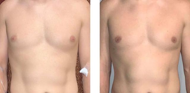 Gynecomastia Surgery result at Whitlock Cosmetic Center of Oklahoma in Tulsa, OK