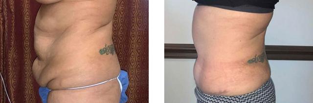 Mommy Makeover result at Whitlock Cosmetic Center of Oklahoma in Tulsa, OK