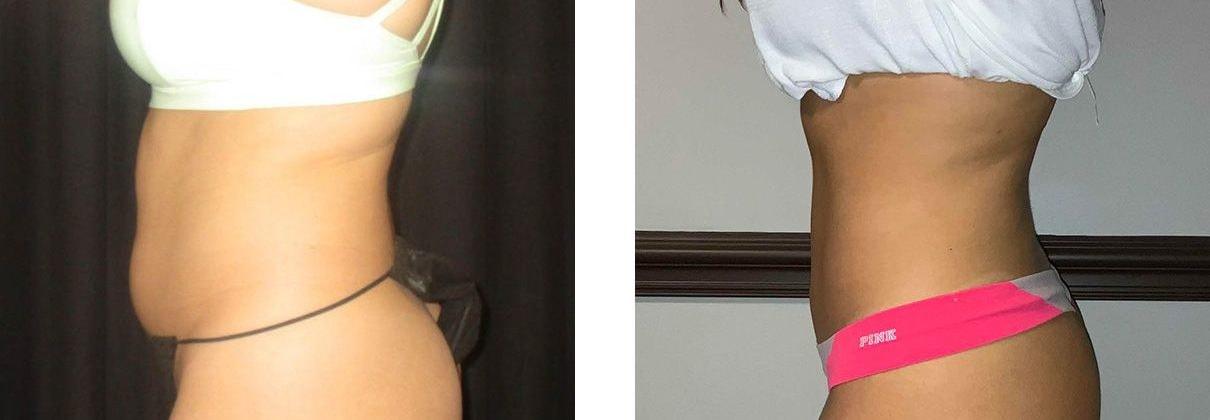 Whitlock Cosmetic Center of Oklahoma liposuction result — Tulsa, OK