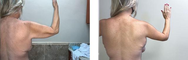 Arm Lift result at Whitlock Cosmetic Center of Oklahoma in Tulsa, OK