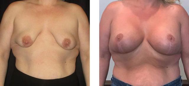 Breast Lift result at Whitlock Cosmetic Center of Oklahoma in Tulsa, OK