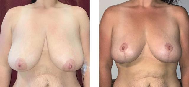 Breast Lift result at Whitlock Cosmetic Center of Oklahoma in Tulsa, OK