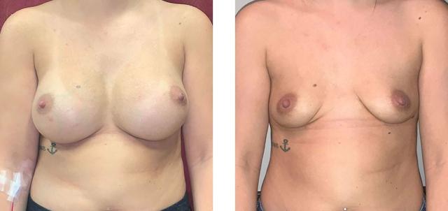 Breast Lift result at Whitlock Cosmetic Center of Oklahoma in Tulsa, OK