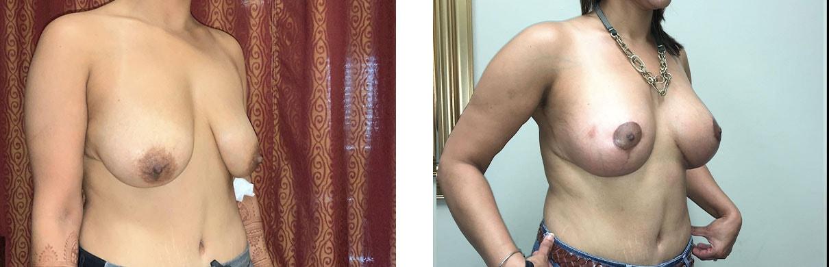 Whitlock Cosmetic Center of Oklahoma breast augmentation result — Tulsa, OK