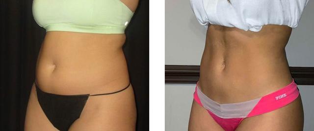 Liposuction result at Whitlock Cosmetic Center of Oklahoma in Tulsa, OK