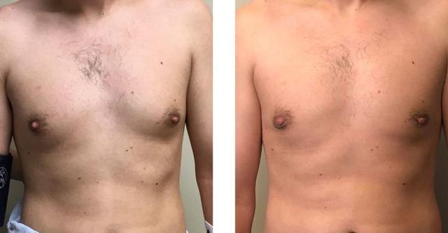 Gynecomastia Surgery result at Whitlock Cosmetic Center of Oklahoma in Tulsa, OK