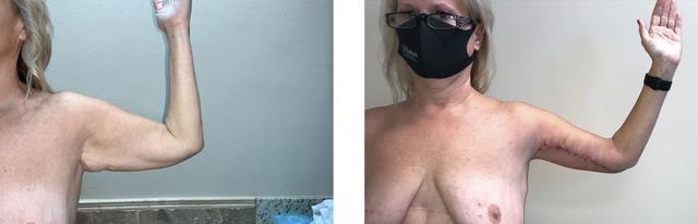 Arm Lift result at Whitlock Cosmetic Center of Oklahoma in Tulsa, OK